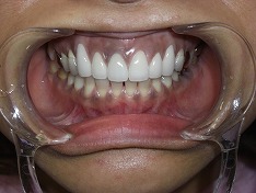 オールセラミックを使用した審美歯科治療症例②　術後