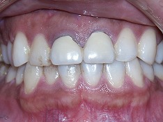 審美歯科の差し替え治療症例①　術前