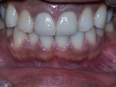 審美歯科の差し替え治療症例①　術後