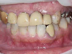 審美歯科の差し替え治療症例②　術前