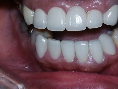 審美歯科の差し替え治療症例②　術後