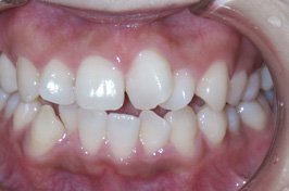 審美歯科の歯列矯正治療症例　術前