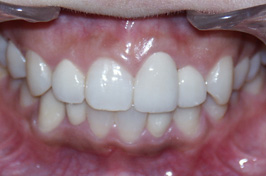 審美歯科の歯列矯正治療症例　術後