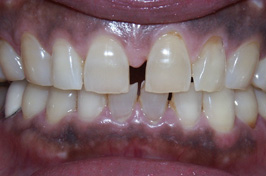 審美歯科の前歯矯正治療（歯冠空隙の改善）症例　術前