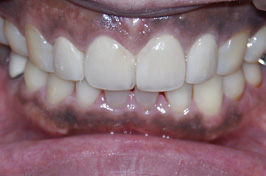 審美歯科の前歯矯正治療（歯冠空隙の改善）症例　術後