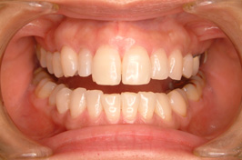 審美歯科のラミネートべニア治療症例①　術前