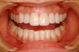 審美歯科のラミネートべニア治療症例①　術後