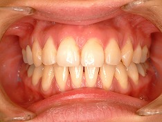 審美歯科のラミネートべニア治療症例②　術前