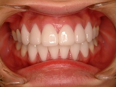 審美歯科のラミネートべニア治療症例②　術後