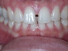 審美歯科のラミネートべニア治療症例③　術前