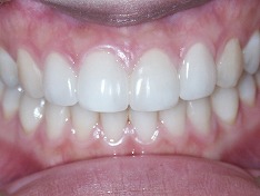 審美歯科のラミネートべニア治療症例③　術後